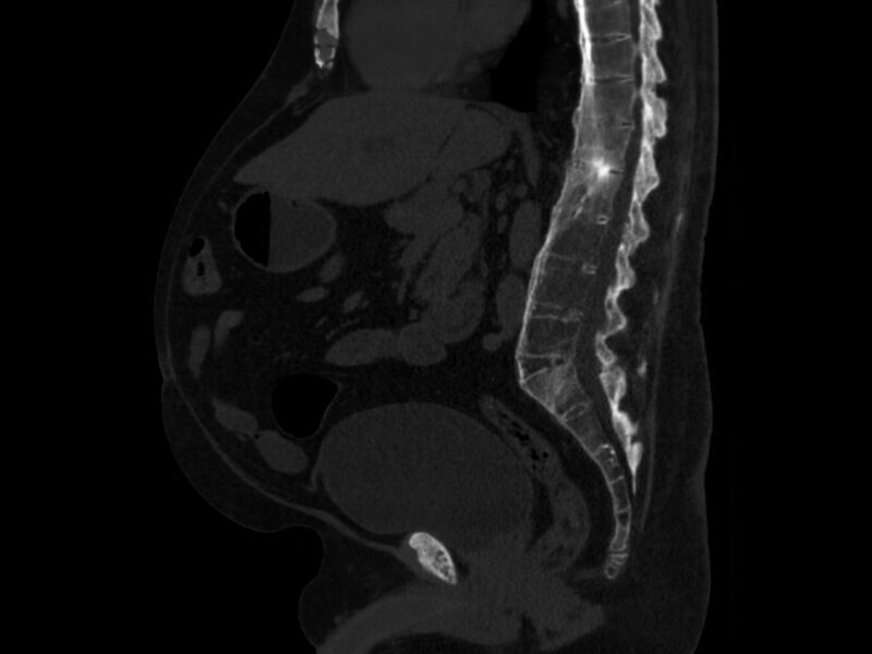 File:Ankylosing spondylitis (Radiopaedia 44609-48357 Sagittal bone window 53).jpg