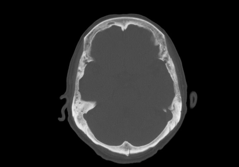 File:Anomalous intracranial venous drainage (Radiopaedia 28161-28418 Axial bone window 14).jpg
