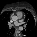 Anomalous origin of left circumflex artery from right coronary sinus (Radiopaedia 72563-83117 B 30).jpg