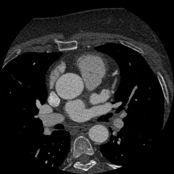 File:Anomalous origin of left circumflex artery from right coronary sinus (Radiopaedia 72563-83117 B 30).jpg