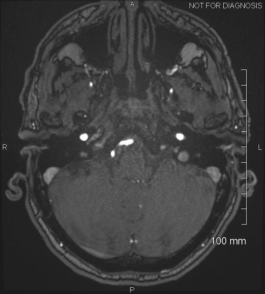 File:Anterior cerebral artery aneurysm (Radiopaedia 80683-94127 Axial MRA 41).jpg