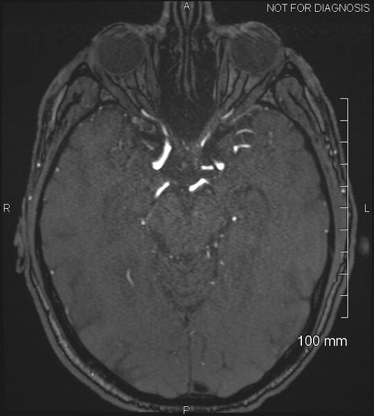 File:Anterior cerebral artery aneurysm (Radiopaedia 80683-94127 Axial MRA 95).jpg
