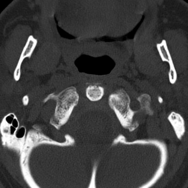 File:Anterior cervical postdiscectomy arthrodesis (Radiopaedia 32678-33646 Axial bone window 12).jpg