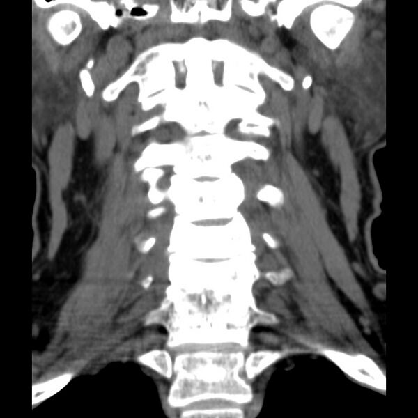 File:Anterior cervical postdiscectomy arthrodesis (Radiopaedia 32678-33646 Coronal non-contrast 13).jpg