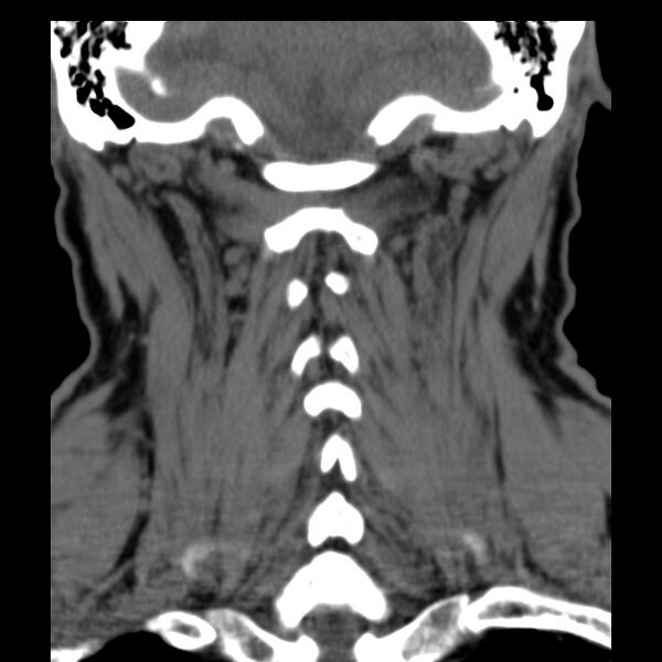 File:Anterior cervical postdiscectomy arthrodesis (Radiopaedia 32678-33646 Coronal non-contrast 27).jpg