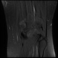 Anterior cruciate ligament tear, Wrisberg rip and bucket-handle tear of medial meniscus (Radiopaedia 75872-87266 Coronal PD fat sat 22).jpg