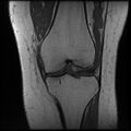Anterior cruciate ligament tear, Wrisberg rip and bucket-handle tear of medial meniscus (Radiopaedia 75872-87266 Coronal T1 13).jpg