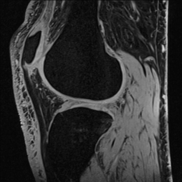 File:Anterior cruciate ligament tear - ramp lesion (Radiopaedia 71883-82322 Sagittal T1 vibe 50).jpg