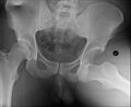 Anterior dislocation of the hip (Radiopaedia 14836).jpg