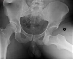 Anterior dislocation of the hip
