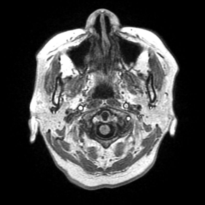 Anti-MOG encephalomyelitis (Radiopaedia 73831-84646 Axial T1 3).jpg
