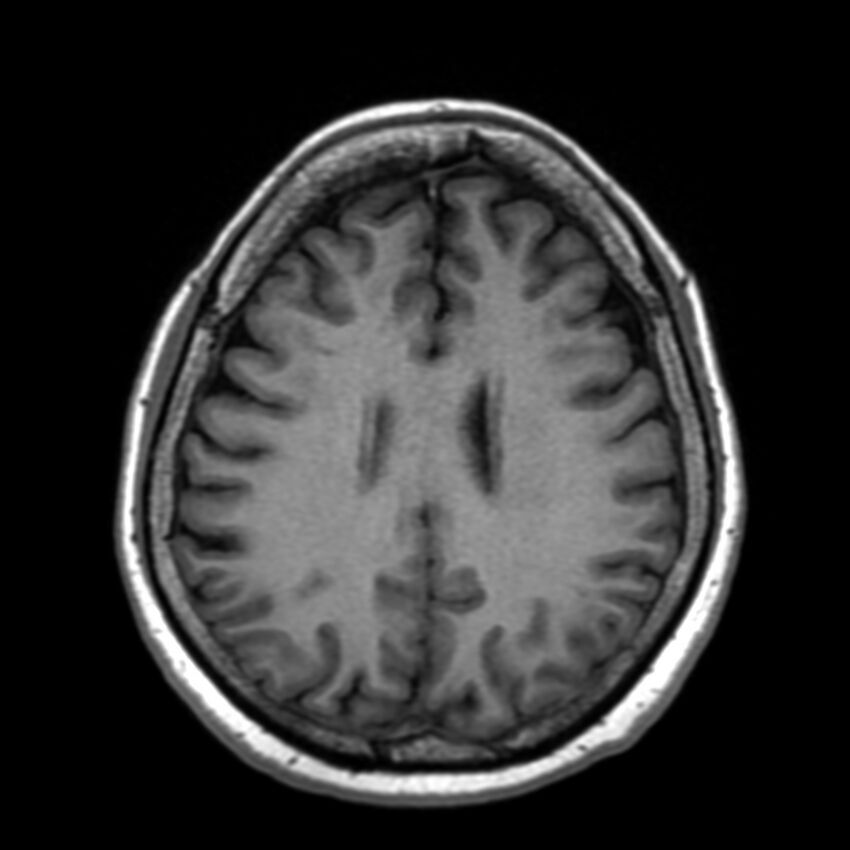 Anti-MOG encephalomyelitis (Radiopaedia 73831-84646 Axial T1 34).jpg