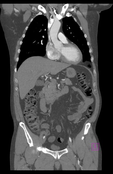 File:Aortectomy and axillary-bifemoral bypass (Radiopaedia 28303-28545 C 39).jpg