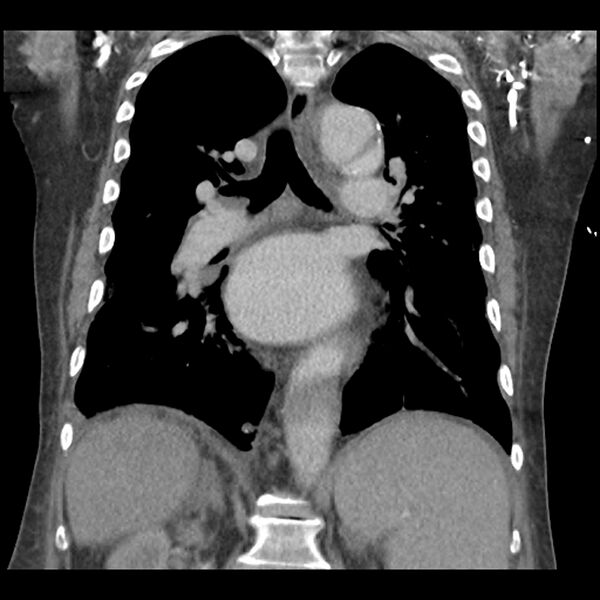 File:Aortic arch graft infection (FDG PET-CT) (Radiopaedia 71975-82437 Coronal 38).jpg