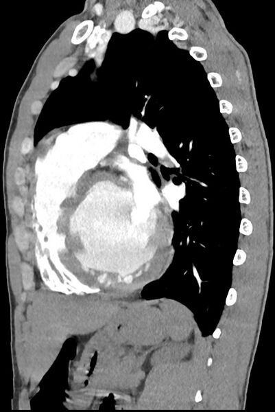 File:Aortic coarctation with aneurysm (Radiopaedia 74818-85828 B 103).jpg