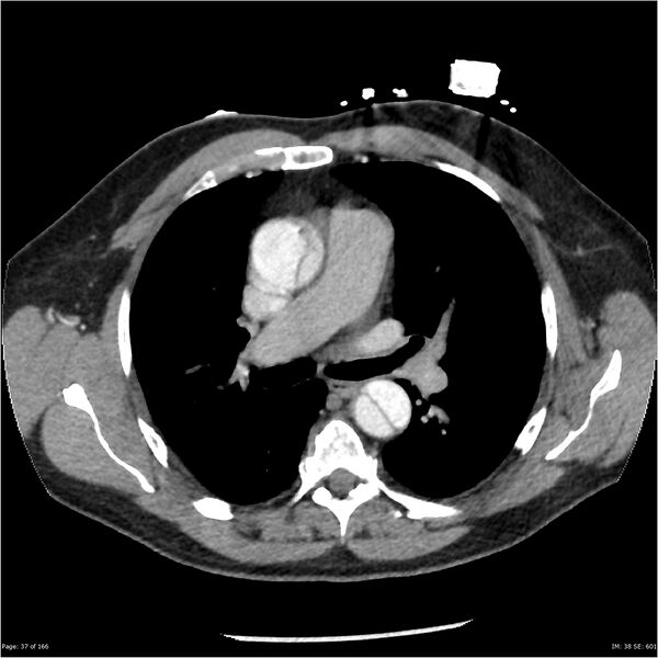 File:Aortic dissection- Stanford A (Radiopaedia 37759-39664 A 28).jpg