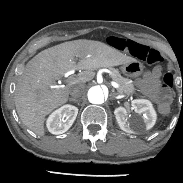 File:Aortic dissection - DeBakey Type I-Stanford A (Radiopaedia 79863-93115 A 42).jpg
