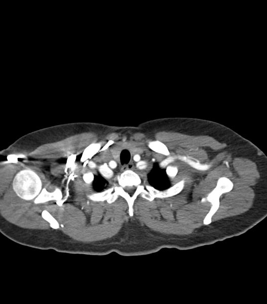 File:Aortic dissection with renal ischemia (Radiopaedia 76573-88338 A 3).jpg