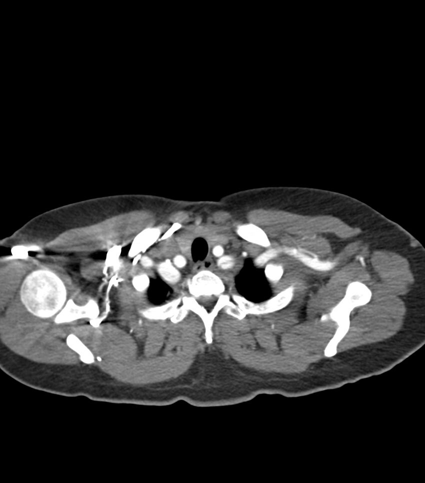 Aortic dissection with renal ischemia (Radiopaedia 76573-88338 A 3).jpg