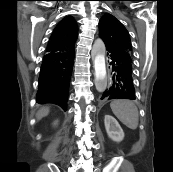 File:Aortic dissection with rupture into pericardium (Radiopaedia 12384-12647 B 34).jpg