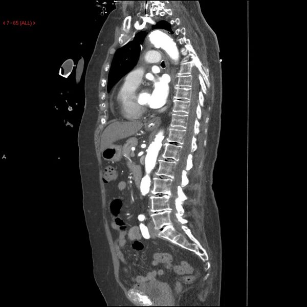 File:Aortic intramural hematoma (Radiopaedia 27746-28001 C 34).jpg