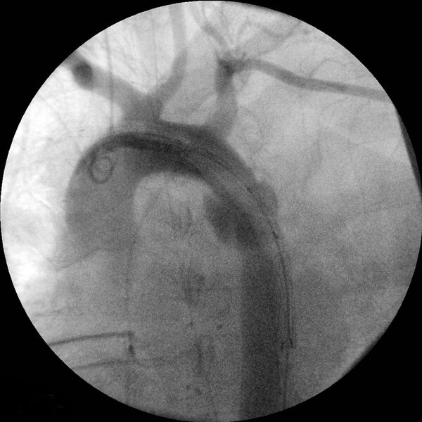 File:Aortic transection and subclavian steal (Radiopaedia 8711-9517 Initial 1).jpg