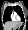 Aortic valve non-coronary cusp thrombus (Radiopaedia 55661-62189 C 23).png