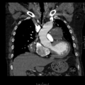 Aorto-coronary bypass graft aneurysms (Radiopaedia 40562-43157 B 17).png