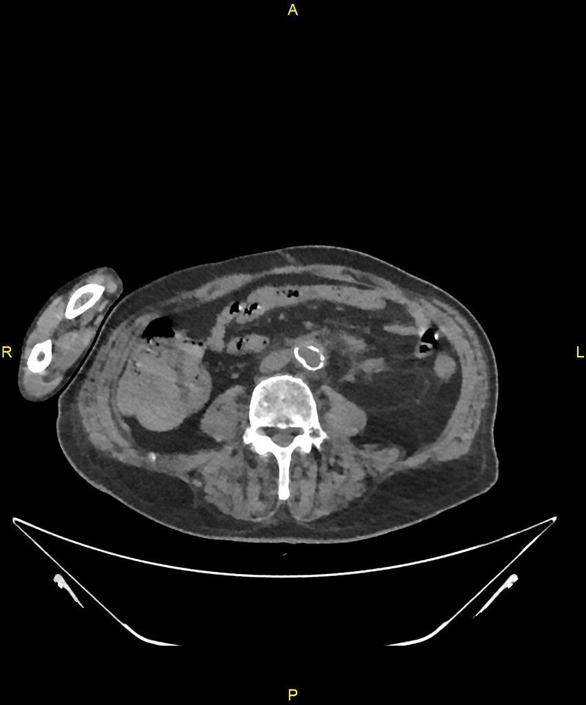 Aortoenteric fistula (Radiopaedia 84308-99603 Axial non-contrast 218).jpg