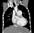 Aortopulmonary window, interrupted aortic arch and large PDA giving the descending aorta (Radiopaedia 35573-37074 D 29).jpg