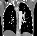 Aortopulmonary window, interrupted aortic arch and large PDA giving the descending aorta (Radiopaedia 35573-37074 D 47).jpg