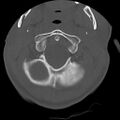 Apical pneumothorax on cervical spine CT (Radiopaedia 45343-49368 Axial bone window 10).jpg