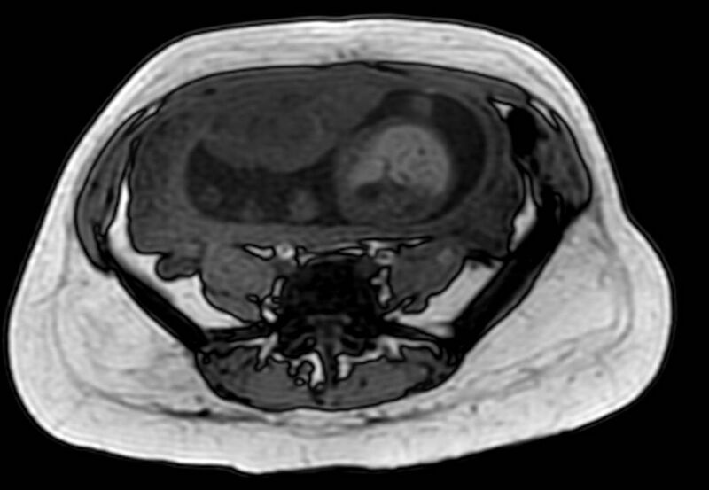 File:Appendicitis in gravida (MRI) (Radiopaedia 89433-106395 D 45).jpg