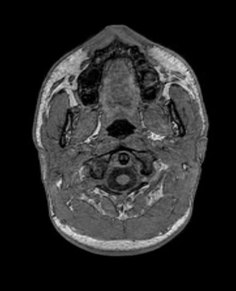 File:Arachnoid cyst- extremely large (Radiopaedia 68741-78451 Axial T1 2).jpg