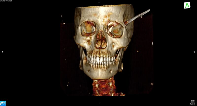 File:Arrow injury to the head (Radiopaedia 75266-86388 3D horizontal 2).jpg