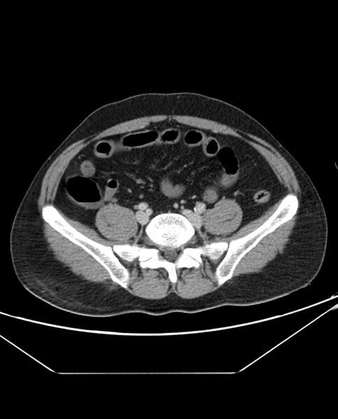 File:Arterial occlusive mesenteric ischemia (Radiopaedia 84641-100054 A 85).jpg