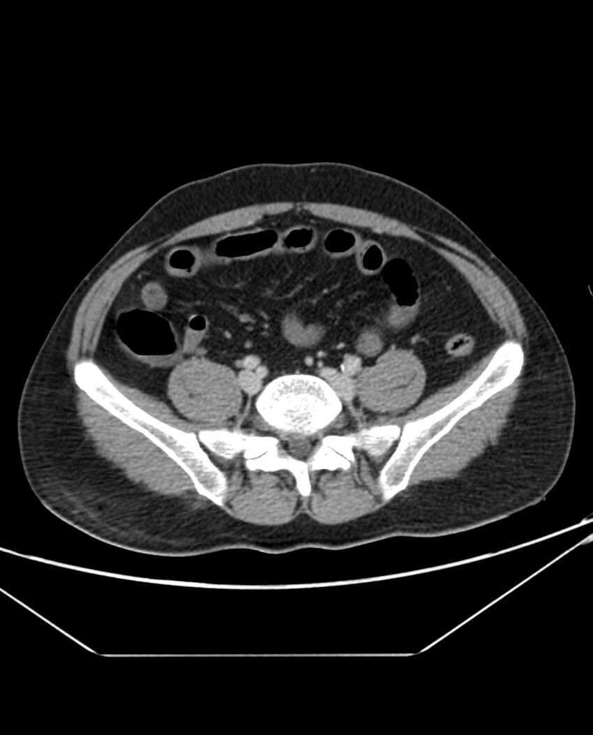 Arterial occlusive mesenteric ischemia (Radiopaedia 84641-100054 A 85).jpg
