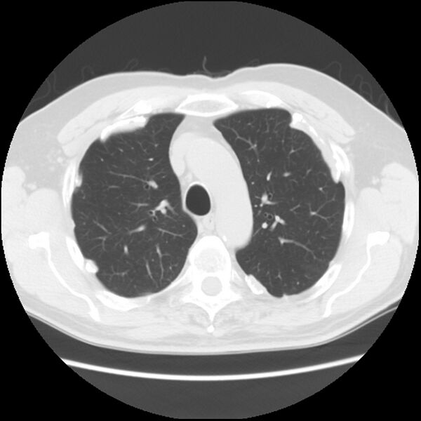 File:Asbestos-related pleural plaques (Radiopaedia 39069-41255 Axial lung window 21).jpg