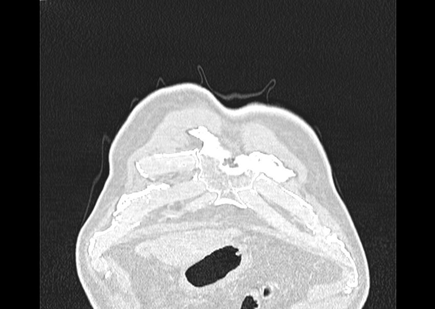 Asbestos pleural placques (Radiopaedia 57905-64872 Coronal lung window 1).jpg