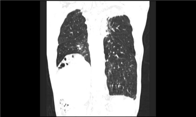 File:Aspergilloma (Radiopaedia 20788-20701 Coronal lung window 14).jpg