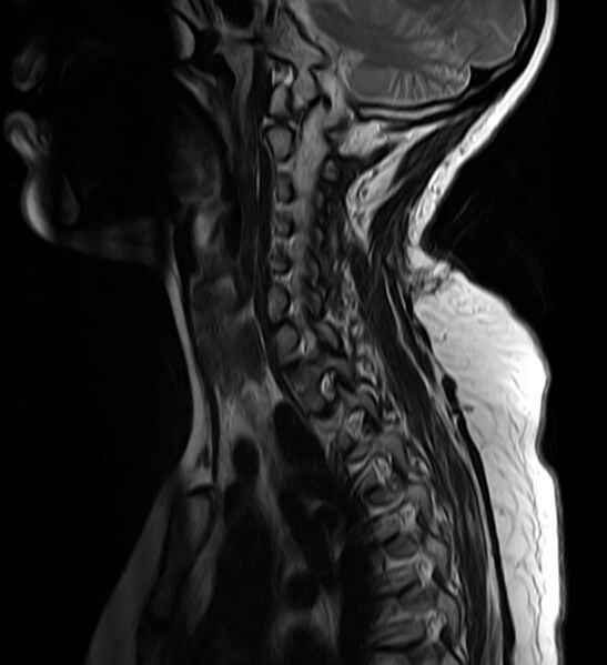 File:Astrocytoma - spinal cord (Radiopaedia 69769-79758 Sagittal T2 4).jpg