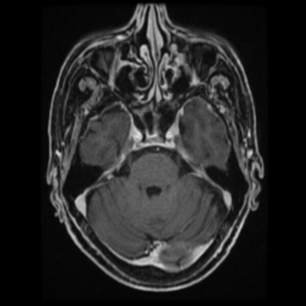 File:Atypical meningioma (Radiopaedia 45535-49629 Axial T1 C+ 27).jpg