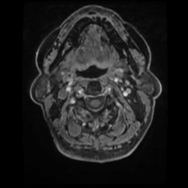 File:Atypical meningioma (Radiopaedia 45535-49629 Axial T1 C+ 5).jpg