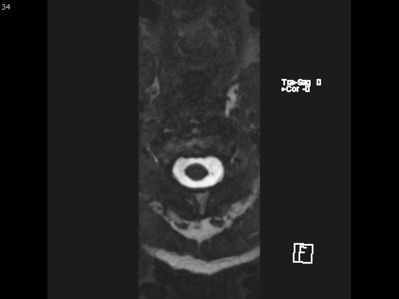 File:Atypical meningioma - intraosseous (Radiopaedia 64915-74572 Axial CISS 34).jpg