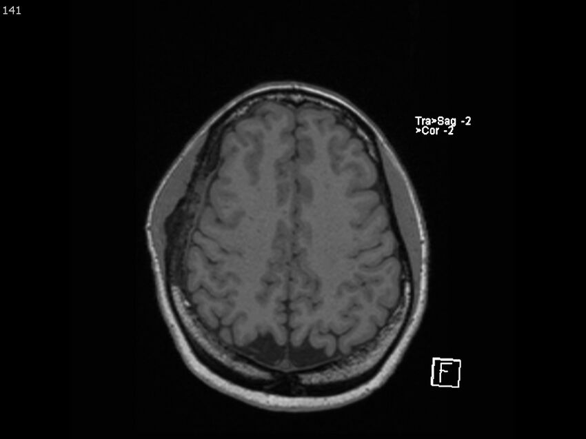 Atypical meningioma - intraosseous (Radiopaedia 64915-74572 Axial T1 141).jpg