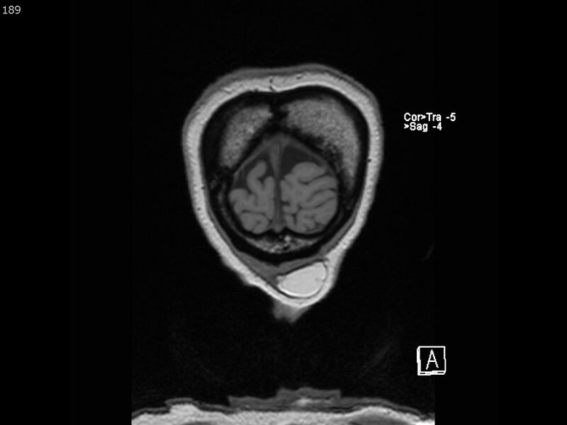 File:Atypical meningioma - intraosseous (Radiopaedia 64915-74572 Coronal T1 189).jpg