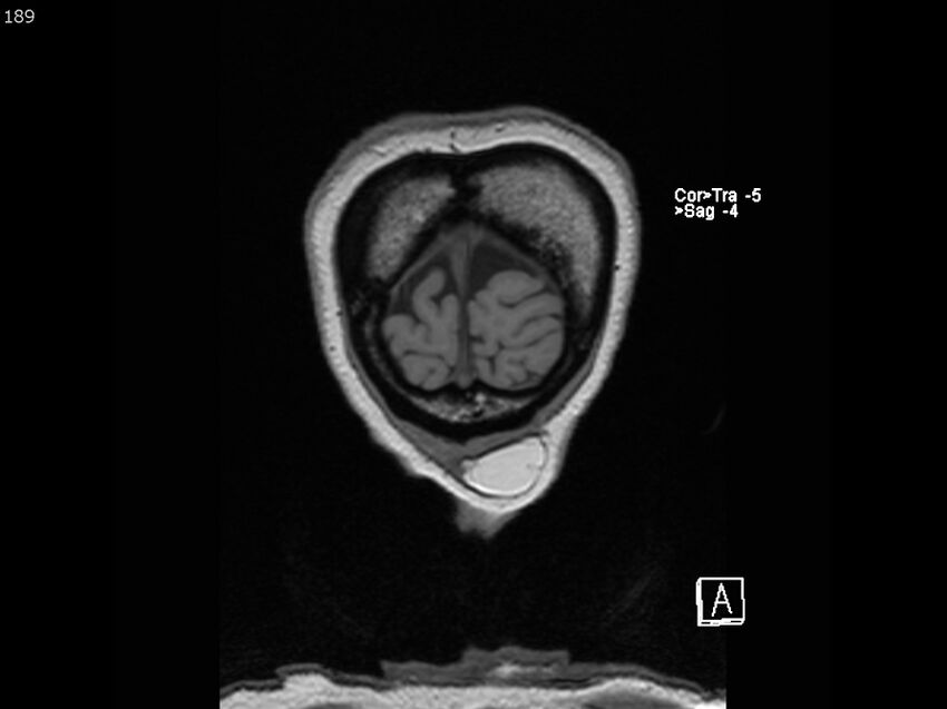 Atypical meningioma - intraosseous (Radiopaedia 64915-74572 Coronal T1 189).jpg