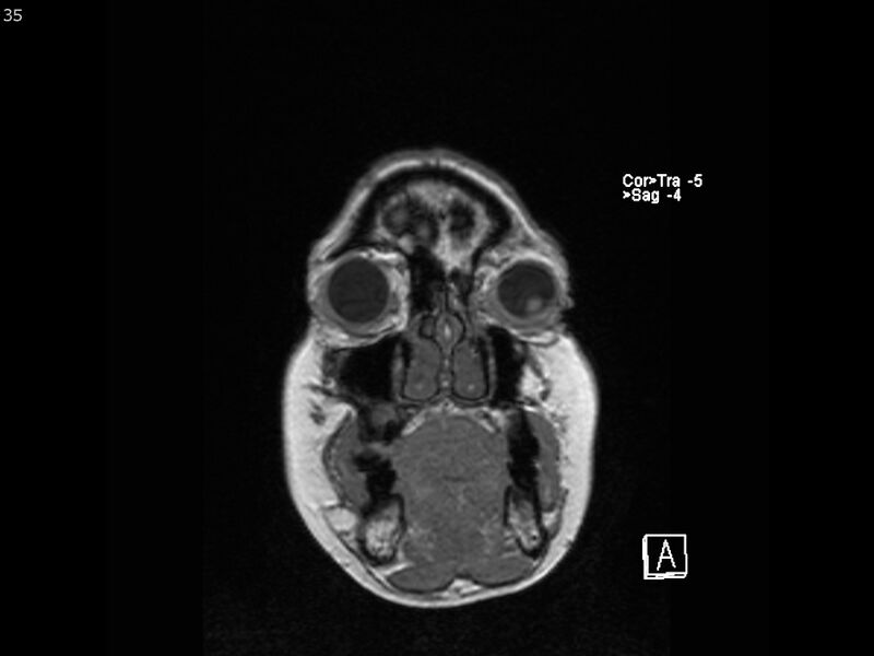 File:Atypical meningioma - intraosseous (Radiopaedia 64915-74572 Coronal T1 35).jpg
