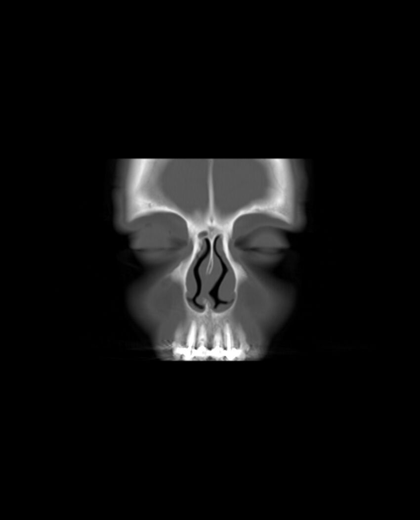 Automastoidectomy with labyrinthine fistula (Radiopaedia 84143-99411 Coronal non-contrast 6).jpg