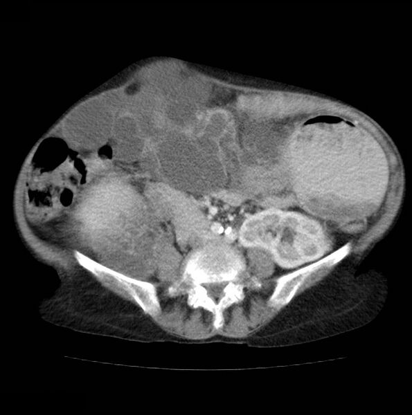 File:Autosomal dominant polycystic kidney disease (Radiopaedia 16777-16490 A 36).jpg